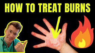 HOW TO TREAT AND MANAGE BURNS AND SCALDS  DOCTOR EXPLAINS plus first aid tips [upl. by Grae885]