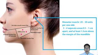 Advanced Botox Injection Techniques for Dentists  Part 3 Masseter Hypertrophy [upl. by Randie894]