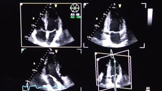 Triplane Echokardiographie triplane echocardiography [upl. by Peednus]