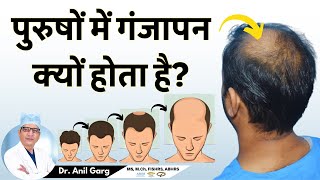 पुरुषों में गंजापन क्यों होता है  Why Some Men Go Bald  Going Bald This Could Be Why [upl. by Smallman]