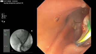 ERCP in totally intradiverticular ampulla [upl. by Robinette]