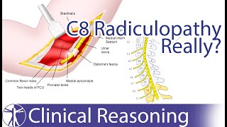 Ulnar Nerve Entrapment mimicking C8 Radiculopathy [upl. by Eiznik801]