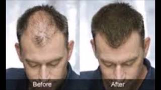 Seborrheic Dermatitis Hair Loss Before And After Seborrheic Dermatitis Hair Loss Before And After [upl. by Annaeerb]