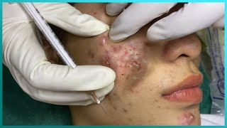 Big Cystic Acne Blackheads Extraction Blackheads amp Milia Whiteheads Removal Pimple Popping [upl. by Fidela898]