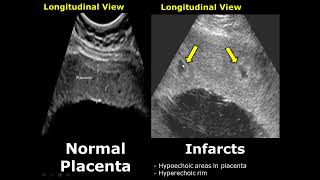 Placenta Ultrasound Normal Vs Abnormal Image Appearances Comparison  Placental Pathologies on USG [upl. by Porett]