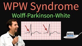 WPW  WolffParkinsonWhite Syndrome ECG  EKG findings symptoms pathology amp treatment [upl. by Phillane]