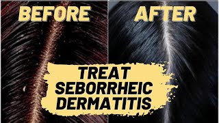 How to Treat Seborrheic Dermatitis Natural Hair Treatment  Repair Your Scalp amp Hair Loss [upl. by Higinbotham893]