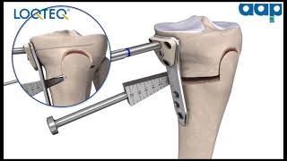 LOQTEQ® High Tibia Osteotomy 45  Surgical Technique [upl. by Sapphira695]