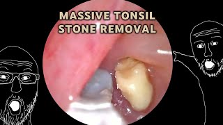 Multitude of Massive Tonsil stones removed  AIM 20 [upl. by Dunc]