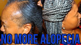 The BEST Way To Install l ALOPECIA Crochet Box Braids Hairstyles l [upl. by Oluas]