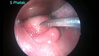 Retropharyngeal Abscess [upl. by Holub]