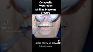 Composite Restoration l Midline Diastema Closure l [upl. by Benedict]