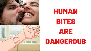 HUMAN BITES ARE DANGEROUS Human Bites What To Do  Human Bites Treatment Symptoms Complications [upl. by Jessalyn]