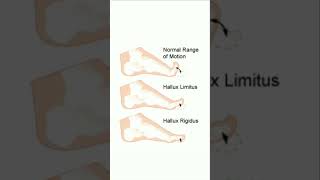 normal range of motion to hallux limitus n hallux rigidus  treatment for next video 👍👍 [upl. by Nayr]