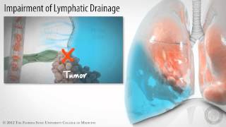 Pulmonary Edema vs Pleural Effusion [upl. by Eilama]