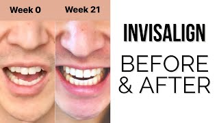 Invisalign Before and After Finally Done  Vlog 25  Joe Yoon [upl. by Nairrod]