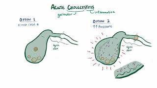 Acute cholecystitis causes symptoms diagnosis treatment amp pathology [upl. by Nathalia181]