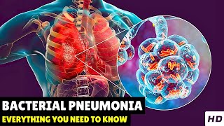 Bacterial Pneumonia – Causes Signs and Symptoms Diagnosis amp Treatment [upl. by Aliuqa828]