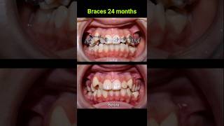 Braces correct all cases of crooked teeth braces orthodontist bracket [upl. by Bolton]