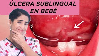 Úlcera sublingual en bebés [upl. by Kolodgie]