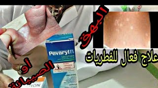 علاج البهاق وجميع انواع الفطريات [upl. by Yhtuv]