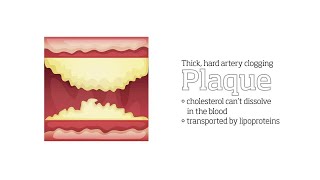 Cholesterol and Stroke  Dr Mark Gloth [upl. by Volny928]