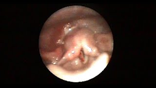 Endoscopic Assessment of Pharynx and Larynx After Blunt Injury To The Neck [upl. by Gates]