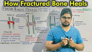 Fracture Healing Process Repair of Fractured Bone [upl. by Enyledam]