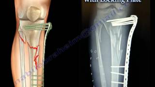 External Fixation With Locking Plate  Everything You Need To Know  Dr Nabil Ebraheim [upl. by Ainuj]