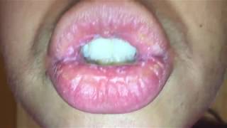 Exfoliative Cheilitis  August 8 2017  Day 2 of Nothing on my Lips [upl. by Ayifas984]