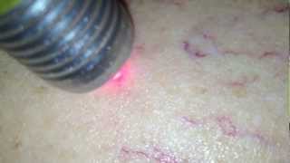 LASER TRANSDERMICO EM TELANGIECTASIAS [upl. by Ailekat]