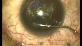 SMILE Dissector ASICO Small Incision Lenticule Extraction [upl. by Artimid]