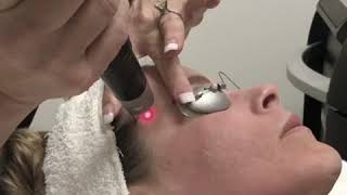 PicoSure Laser Skin Rejuvenation [upl. by Alyk668]