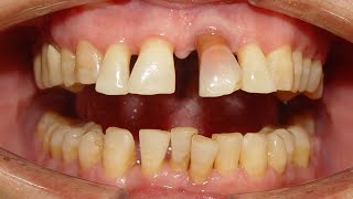 Severe Median Diastema due to Pathological drifting of Upper front teeth [upl. by Stafford963]