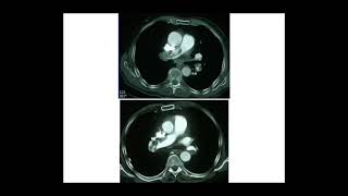 EMBOLIE PULMONAIRE Pr M METAHRI [upl. by Hilary]