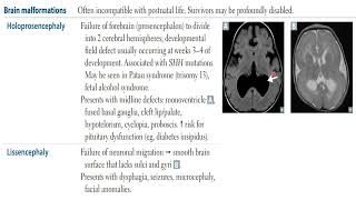 USMLE STEP 1  Neurology  Neural defects Brain malformation [upl. by Islehc]