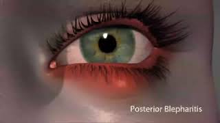 What is Blepharitis amp How to treat it [upl. by Reeva637]