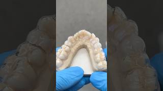 Double Premolar Essix Appliance EnvisiontecMain envisiontec lsk121shorts dentist [upl. by Lyred84]