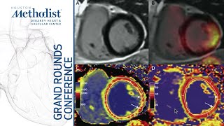 Role of MultiModality Imaging for the Evaluation of Cardiac Sarcoidosis APatel MD March 24 2022 [upl. by Helge]