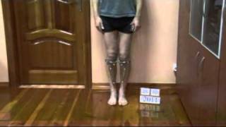 Bow legs genu varum correction treatment  UK patient experience [upl. by Chilt]