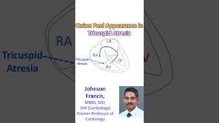 Onion peel appearance in tricuspid atresia [upl. by Esinereb]