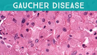 Gaucher disease involving bone lysosomal storage disorder glucocerebrosidase deficiency pathology [upl. by Nnanerak]