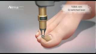 ClearChoice a dual laser approach to onychomycosis from Alma Lasers [upl. by Varhol]