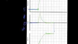 Ventilator Mode amp Waveforms Review [upl. by O'Donoghue]