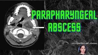 171Parapharyngeal Abscess surgeryeducation shortnotes medicalstudent ent clinicalexamination [upl. by Monty]