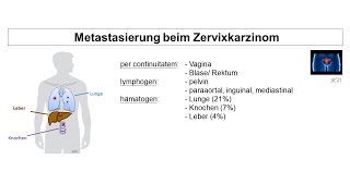 Metastasierung beim Zervixkarzinom  Strahlentherapie Prof Hilke Vorwerk [upl. by Nilekcaj]