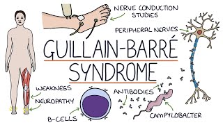 Understanding GuillainBarré Syndrome [upl. by Kandace]