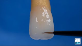 Creating Incisal Edge Effects on Monolithic Veneers and Crown [upl. by Naasar676]