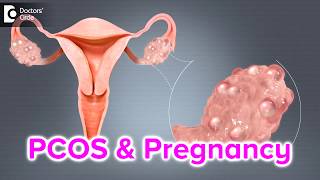 What happens if I have PCOS and I get pregnant  Dr Bala R [upl. by Guild]