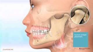 Carriere® Motion™ Appliance for Class II Patient Education Animation 2 [upl. by Kinch292]